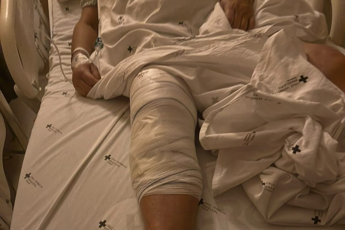 Idosa de 72 anos tem prótese de joelho implantada na perna errada em hospital de Curitiba