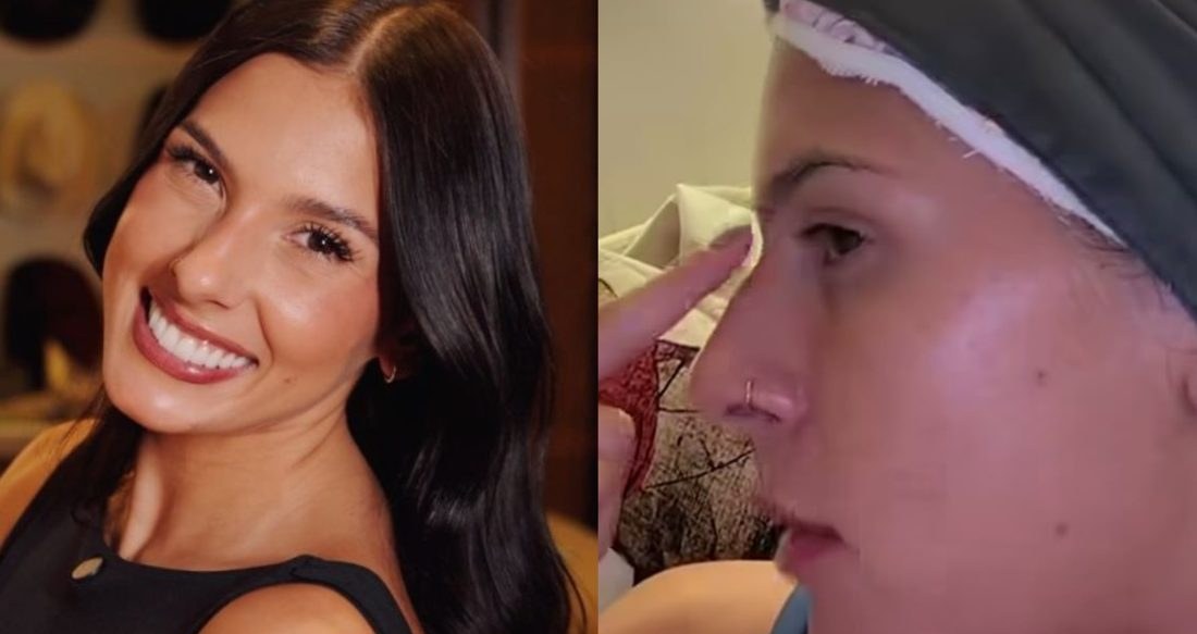 Ana Castela descarta silicone e quer remover o "quebra‑mola" do nariz
